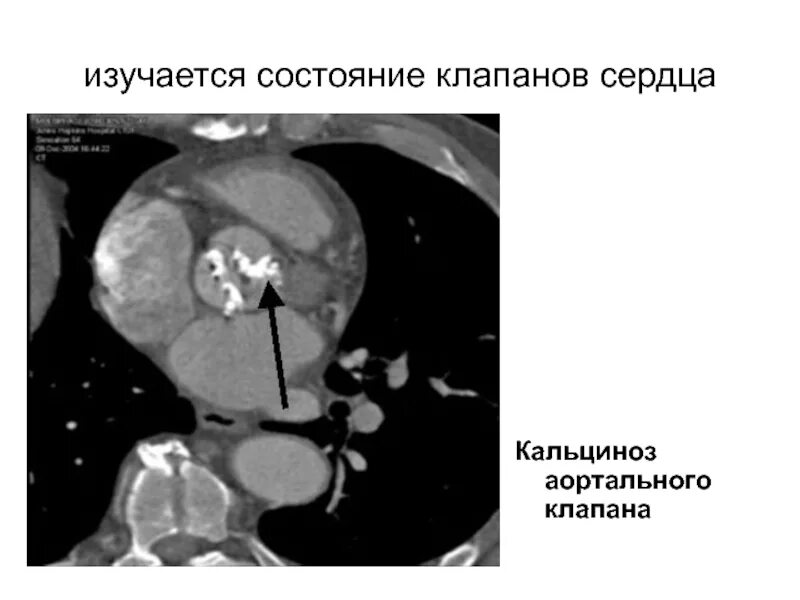 Кальциноз митрального клапана. Кальциноз створок клапанов сердца. Аортальный стеноз кальциноз. Кальцинированный митральный клапан на кт. Кальциноз аортальный клапан сердца.