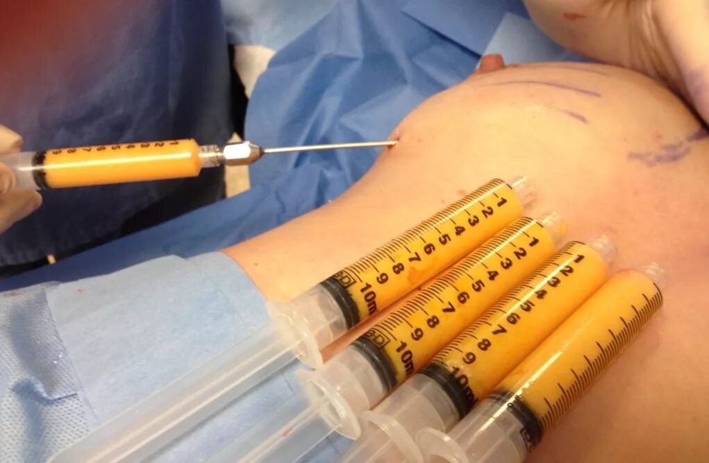 После маммопластики жидкость. После маммопластики жидкость. Келоидные рубцы после маммопластики. Серома импланта молочной железы мрт. Капсулярная контрактура грудного импланта.