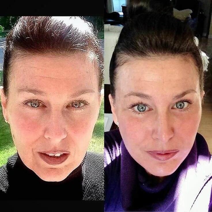 Deep plane. Deep plane facelift edema. Deep plane. Позиции фейслифт. Deep plane.