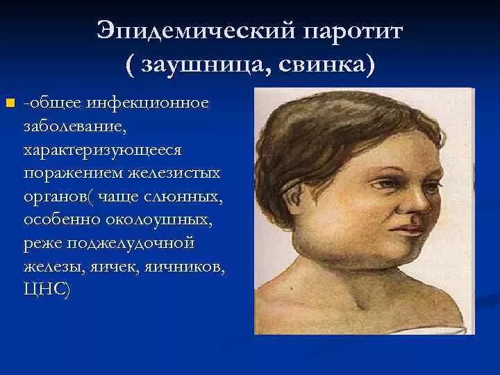 Паротит клиника. Свинка эпидемический паротит. Эпидемический паротит Свинка заушница. Эпидемический паротит поражает.