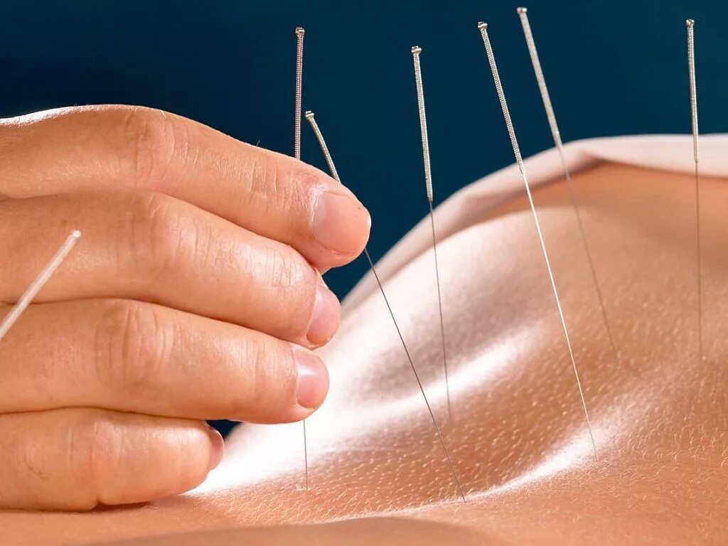 Иглорефлексотерапия. Иглорефлексотерапия живот. Иглорефлексотерапия живот. Терапия иголками. Озонотерапия подкожное обкалывание.