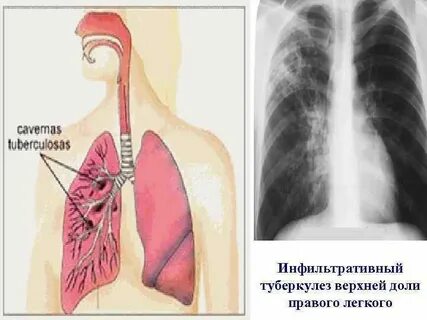 Инфильтрация справа легкие
