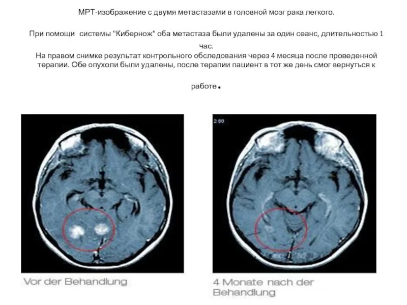 Сколько живут с метастазами в головном мозге. Сколько живут с метастазами в головном мозге