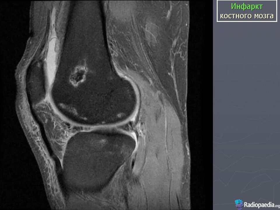 Инфаркт бедренной кости кт. Инфаркт костного мозга коленного сустава мрт. Инфаркт кости коленного сустава мрт. Инфаркт бедренной кости мрт. Участки отека костного мозга