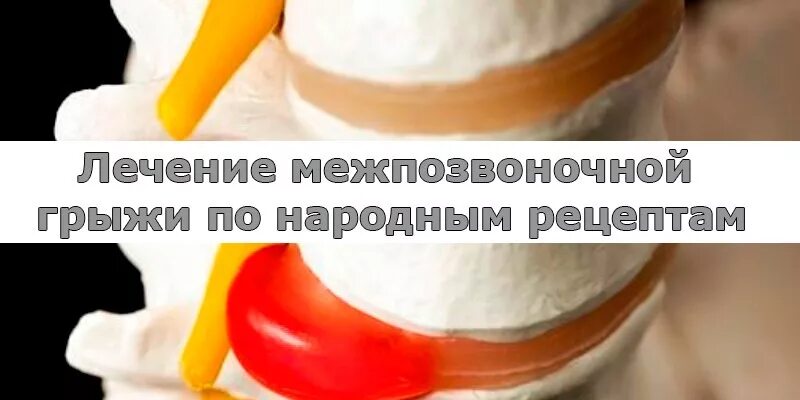 лечение грыжи народными средствами. молитва от грыжи поясничного отдела позвоночника. грыжа позвоночника народными средствами. травы от межпозвоночной грыжи. лечение позвонковой грыжи народными средствами.