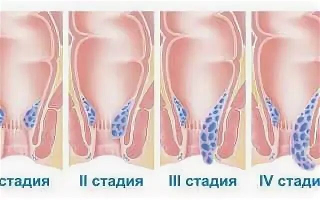 Анальный папиллит фото. Картофель геморрой народные средства. Народные средства от геморроя картофелем.