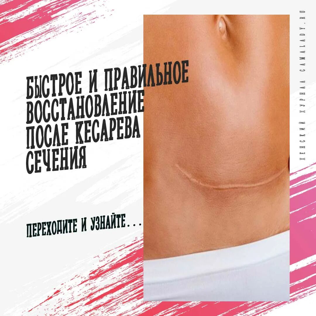 Как правильно встать после кесарева сечения. Кесарево сечение восстановление. восстановление после кесарева сечения. реабилитация после кесарева сечения. реабилитация после кесарево сечение.