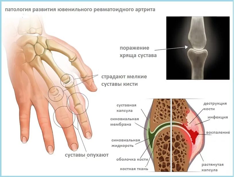 Ревматоидный артрит суставов кистей. Ювенильный ревматоидный артрит. Ревматоидный артрит поражение суставов. Ювенильный ревматоидный артрит суставная форма. Ревматоидный артрит пораженные суставы.