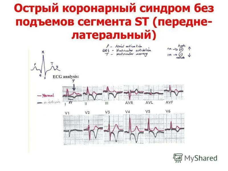 Без подъема st на экг. Острый коронарный синдром без подъема сегмента St ЭКГ. Инфаркт миокарда с подъемом сегмента ст ЭКГ. ЭКГ Окс без подъема сегмента St. ЭКГ Окс с подъемом St и без подъема.