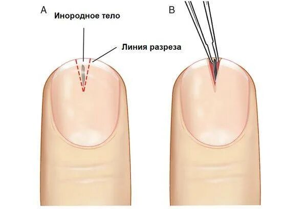 Как удалить глубокую занозу из пальца. Как удалить глубокую занозу из пальца