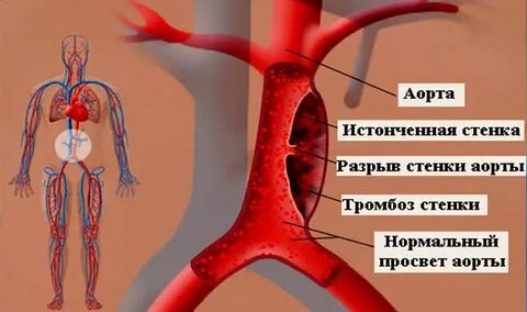 Разрыв аневризмы аорты