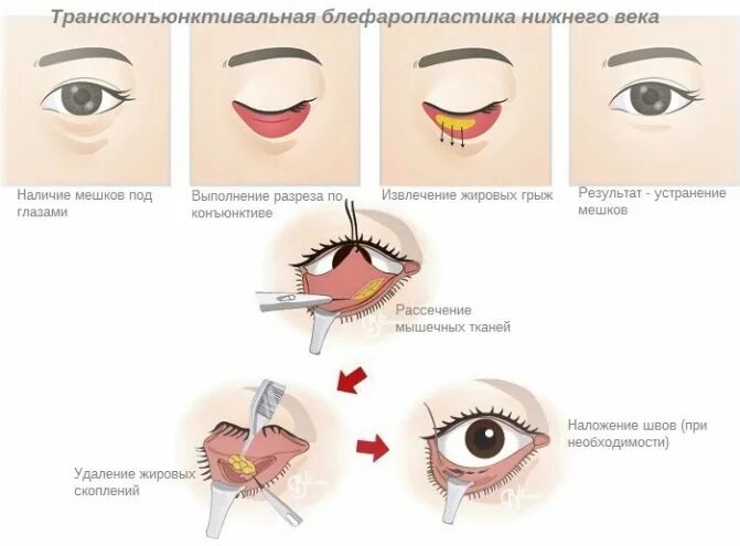 Разрез век. Трансконъюнктивальная блефаропластика верхних век. блефаропластика нижних век схема операции. трансконъюнктивальная пластика нижних век. трансконъюнктивальная блефаропластика схема.