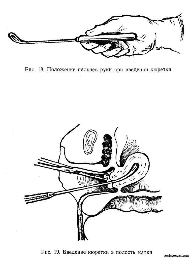 Восстановление после выскабливания. Выскабливание эндометрия. Диагностическое выскабливание шейки матки. Инструменты для выскабливания полости матки.