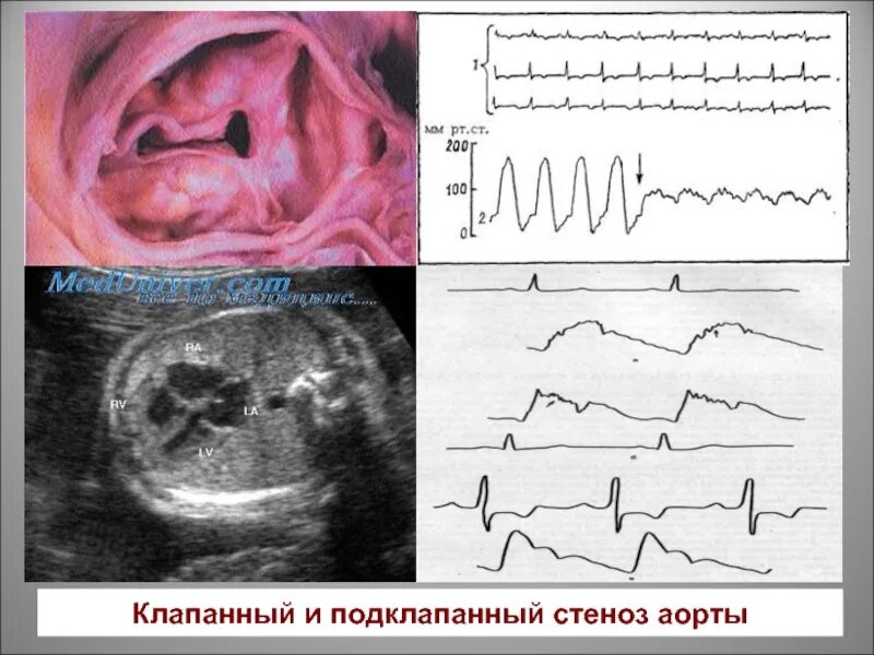 Надклапанный и подклапанный аортальный стеноз. Впс стеноз аортального клапана. Надклапанный и подклапанный аортальный стеноз. Впс стеноз аортального клапана. Врожденный надклапанный стеноз аорты тесты.