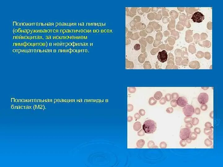 Реакция на лейкоцитарную эстеразу. Цитохимия при острых лейкозах. отрицательная реакция на липиды при остром лейкозе. цитохимические реакции при лейкозах.