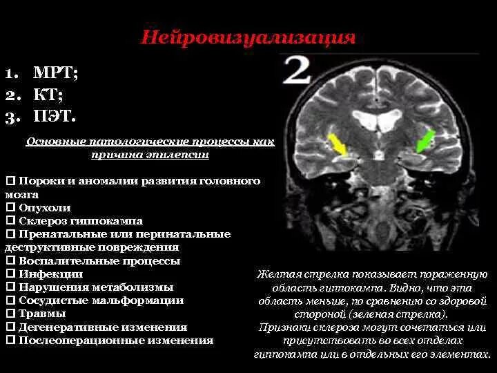 Кт головного мозга при эпилепсии. Эпилепсия на кт. Кт и мрт при эпилепсии. Склероз гиппокампа кт. Диффузная атрофия головного мозга