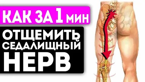 Защемление седалищного нерва снятие боли