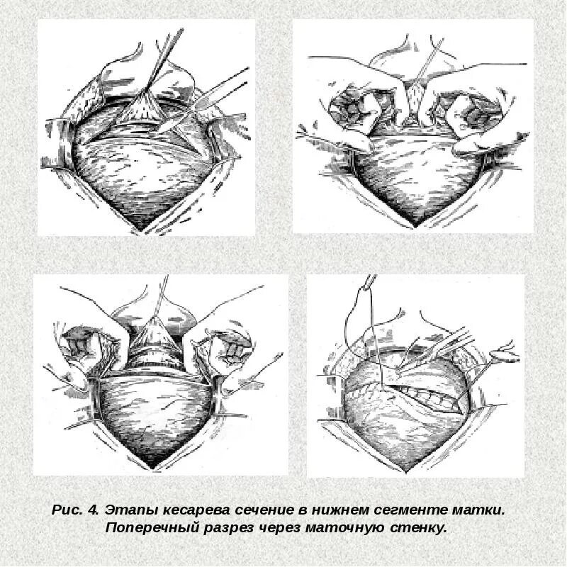 Операция сечения. Методика операции.кесарева сечения. этапы операции при кесарево сечении. схема этапов операции кесарева сечения. экстраперитонеальное кесарево сечение.