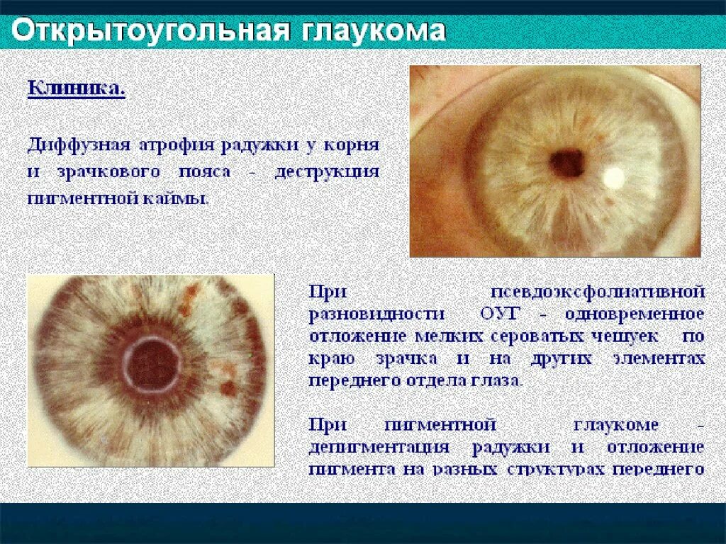 Симптомы открытоугольной глаукомы. Клиника открытоугольной глаукомы. Клиника открыто угольнольной глаукомы.