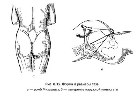 Ромб михаэлиса размеры