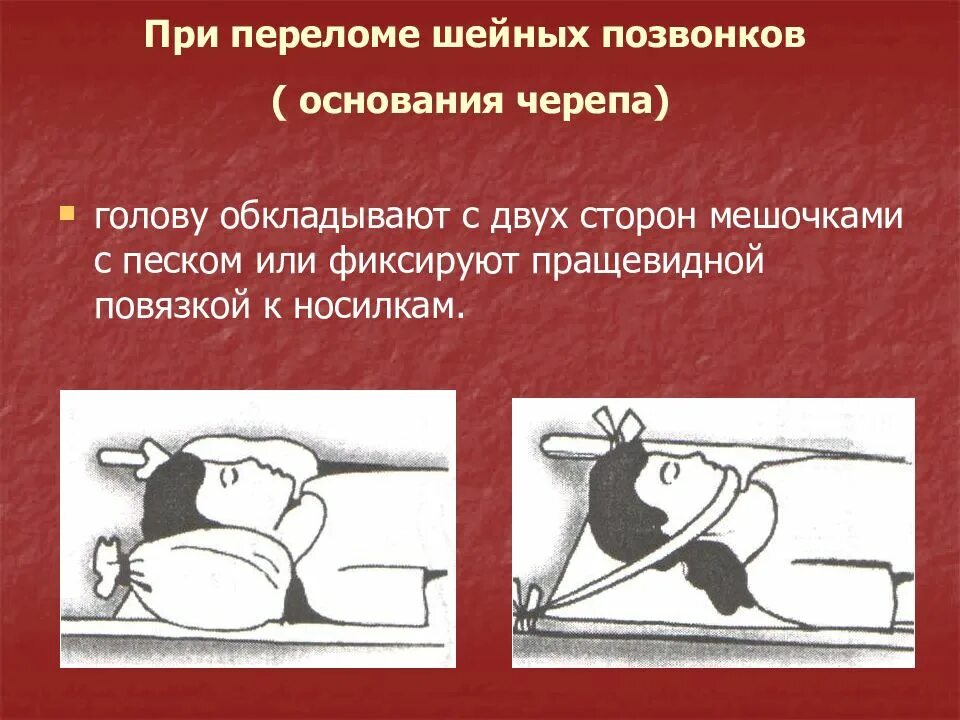 При переломе черепа необходимо. Первая помощь при переломе костей черепа. оказание первой помощи при переломе черепа. перелом костей черепа первая помощь. оказагие первой ромощи пиипереломе черепа.