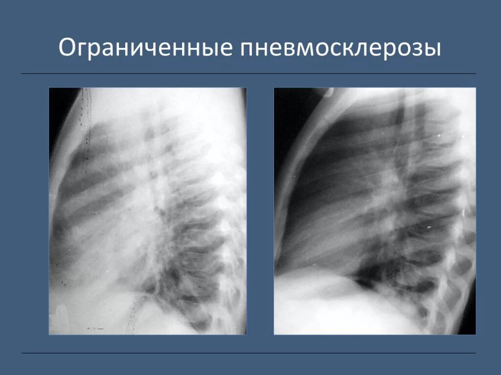 Лечение пневмофиброза легких препараты для лечения. Апикальный пневмофиброз. Базальный пневмосклероз. Гематогенно диссеминированный туберкулез. Лечение пневмофиброза легких препараты.