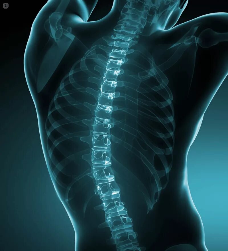 Видео спинная. Scoliosis Spine. Позвоночник цветной. Ревматизм позвоночника.