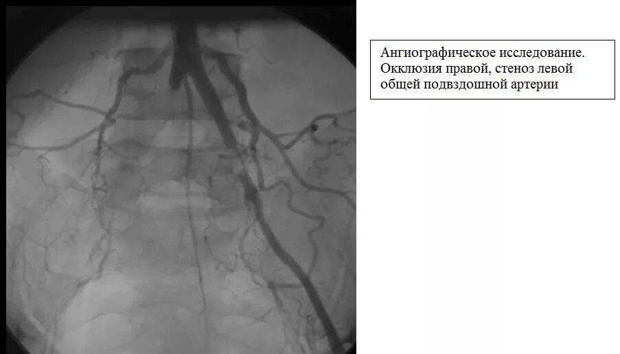 Сужение правой артерии. Аневризма подвздошной артерии кт. Ангиограмма подвздошных артерий. Тромбоз артерии ангиография. Ангиография эмболия подвздошной артерии.