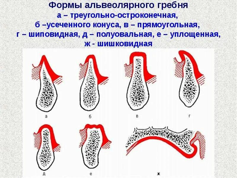 Форма вестибулярного ската альвеолярного отростка верхней челюсти. Форма гребня альвеолярного отростка. Расщепление гребня альвеолярного отростка. Альвеолярный гребень верхней челюсти.