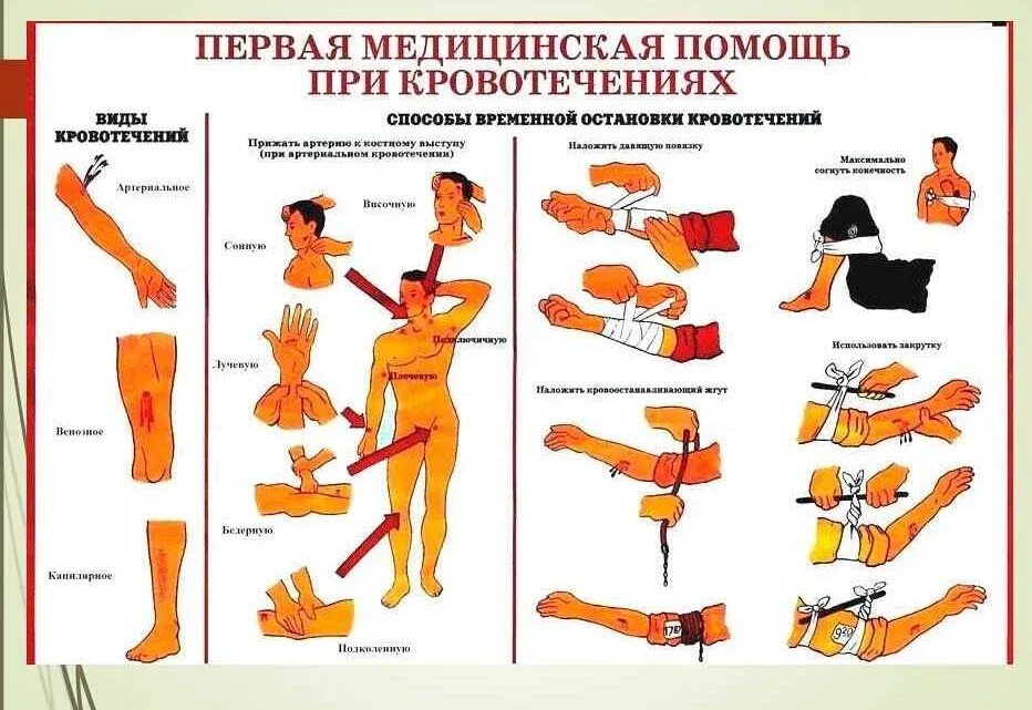 Какую помощь оказать при артериальном кровотечении. Пмп остановка кровотечения. пмп при артериальном кровотечении. порядок первой помощи при кровотечении. схема оказания первой помощи при кровотечениях.