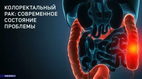 Колоректальный