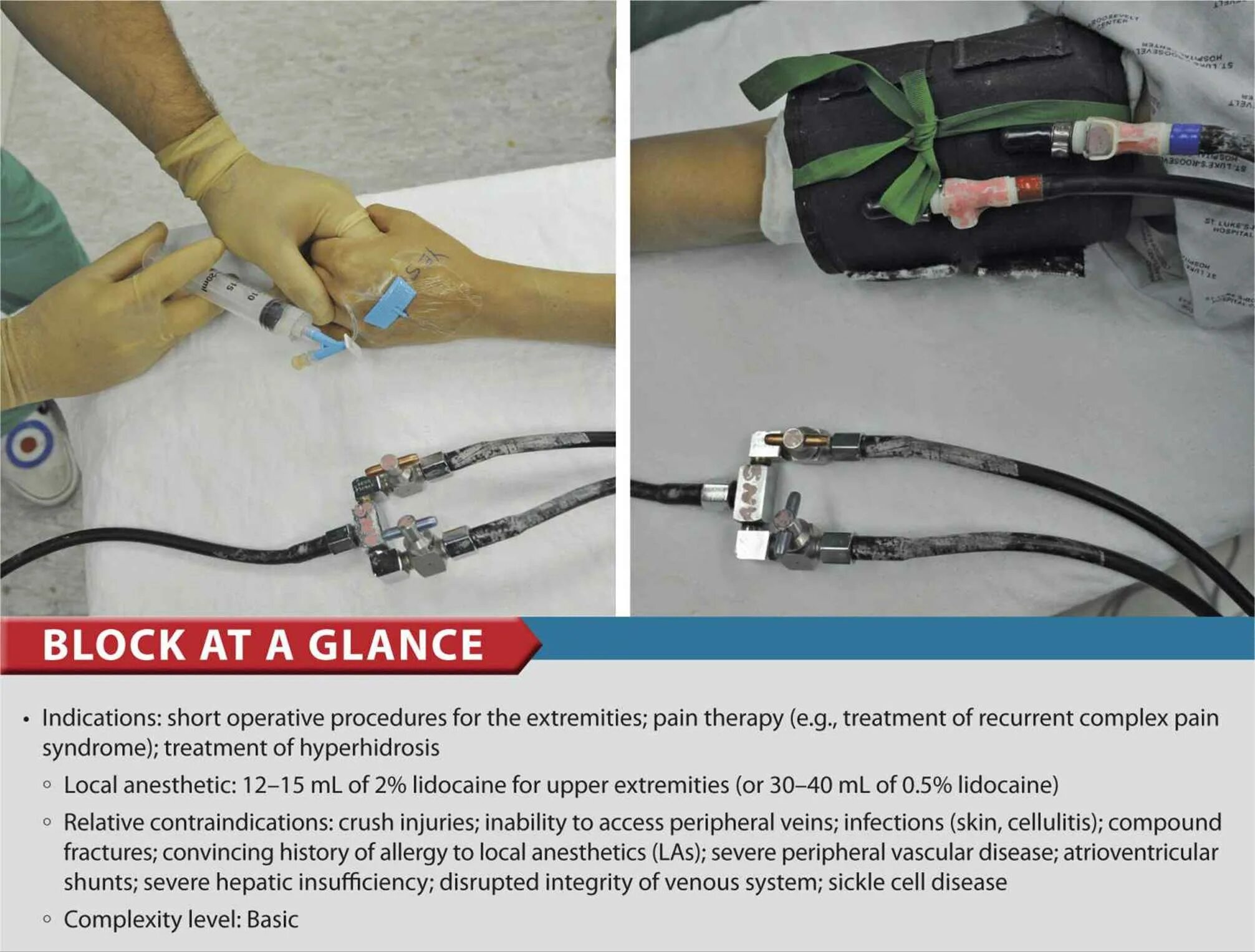 Intravenous не запускается. Блокады периферических нервов адмир хаджич. intravenous bier regional anesthesia. блокада периферического нерва что это такое.