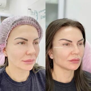 Full face что за процедура