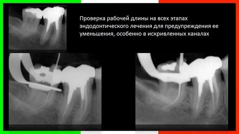 Определение корневых каналов. Рентгенологический метод измерения длины корневого канала. Рентгенологический метод определения длины корневого канала. Табличный метод определения длины корневого канала. Рентгенологический метод измерения корневых каналов.