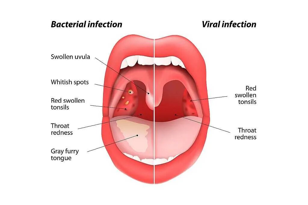 Ангина небных миндалин. Язык за 2 недели