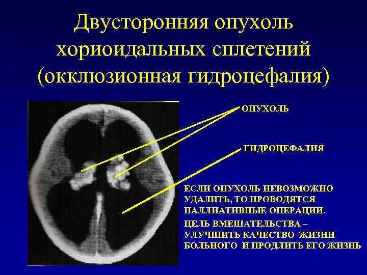 У плода киста мозга сплетения. Хориоидальная щель в головном мозге. Окклюзионная гидроцефалия опухоль.. Киста заднего рога бокового желудочка.