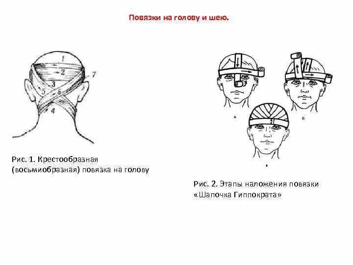Повязки на голову шею. Шапочка Гиппократа повязка техника. Восьмиобразная повязка на голову. Крестообразная повязка на голову. Крестообразная повязка на затылок.