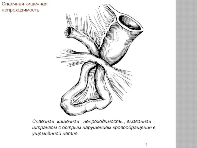 Кишечная непроходимость это. Спайки при кишечной непроходимости. этиопатогенез острой кишечной непроходимости. спаечная непроходимость этиология. острая кишечная непроходимость спастическая.