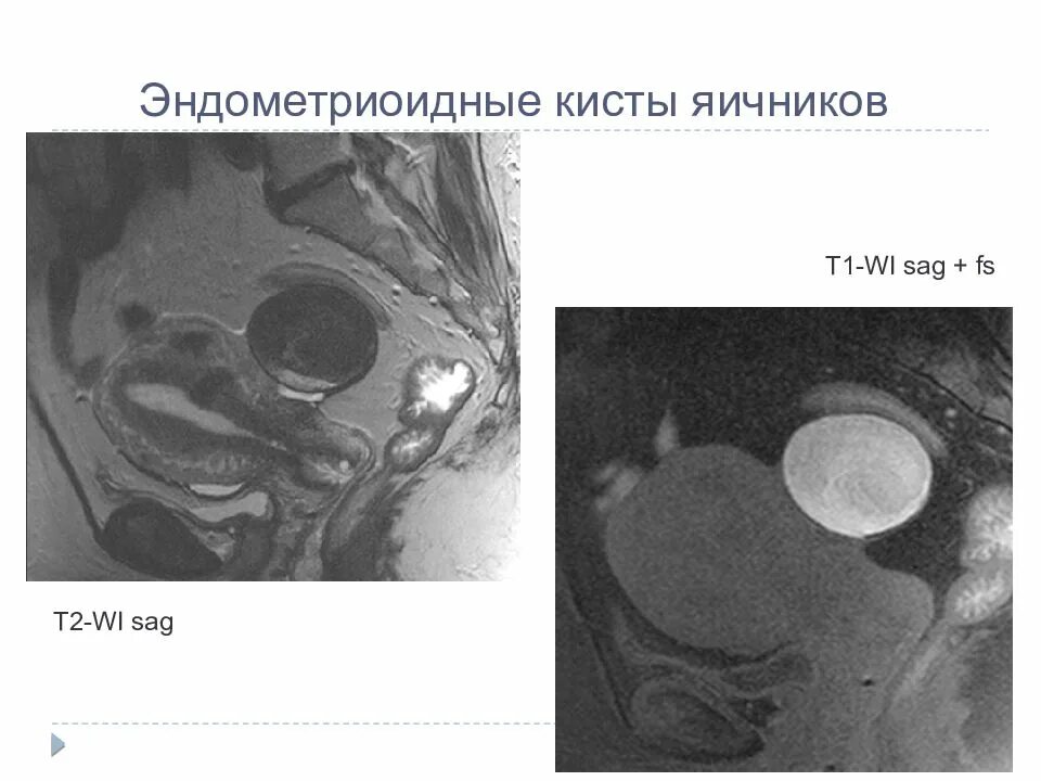 Эндометриоидная киста кт. Эндометриоидная киста яичника мрт. Фолликулярная киста яичника мрт. Эндометриоидная киста яичника кт.