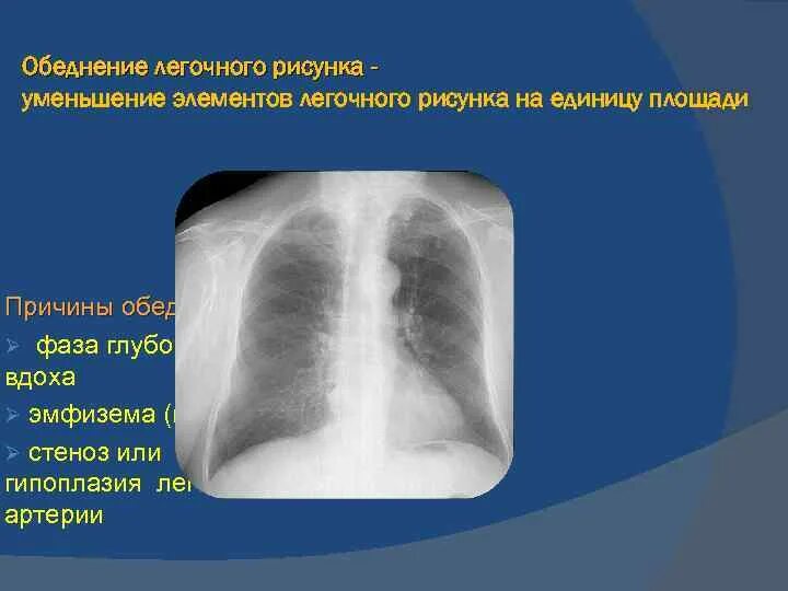 Корень правого легкого. Легочный рисунок в норме и патологии. Элементы легочного рисунка. Анализ легочного рисунка. Усиленный легочный рисунок на рентгене что это.