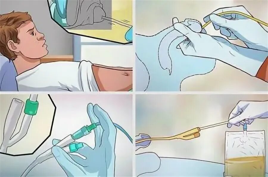 Инстилляция это. Цистоскопию -эндоскопическое исследование мочевого пузыря. Инстилляция это. Инстилляция это. Инстилляция это.