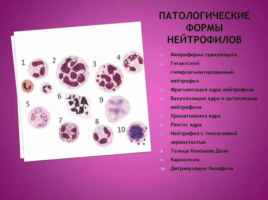 Патология лейкоцитов. Усиленный пикноз ядра нейтрофилов. Токсогенная зернистость нейтрофилов. Нейтрофильные гранулоциты форма клетки. Пикноз ядер нейтрофилов.