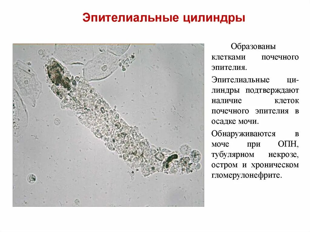 Микроскопия осадка мочи при остром гломерулонефрите. Микроскопия осадка мочи эпителий. Микроскопия осадка слизь. Микроскопия осадка мочи при гломерулонефрите. Слизь в моче плюс