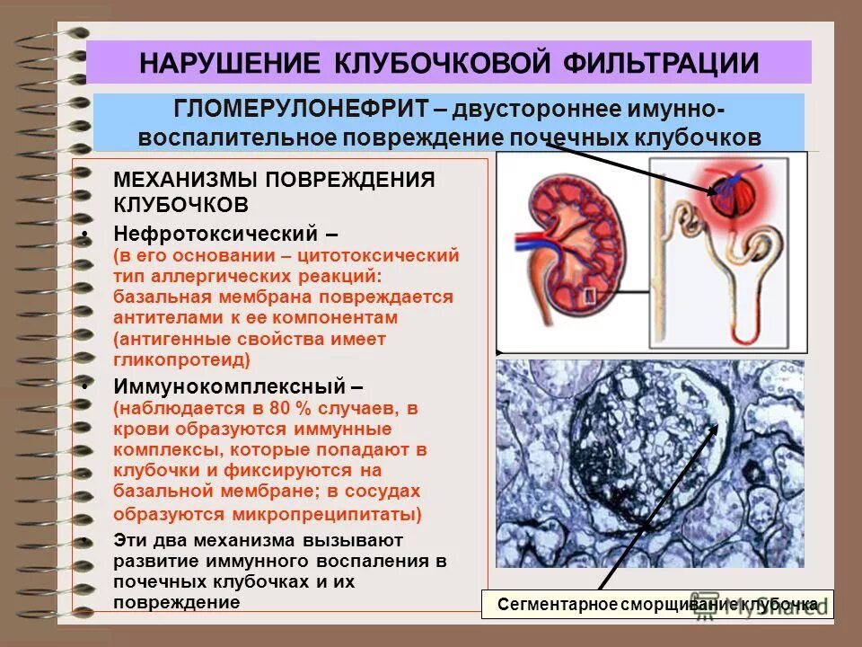 Почему почки называют биологическим фильтром. Механизм нарушения клубочковой фильтрации почек. Клубочки почек гломерулонефрит. Подострый гломерулонефрит клубочки. Механизмы поражения почек при гломерулонефритах.