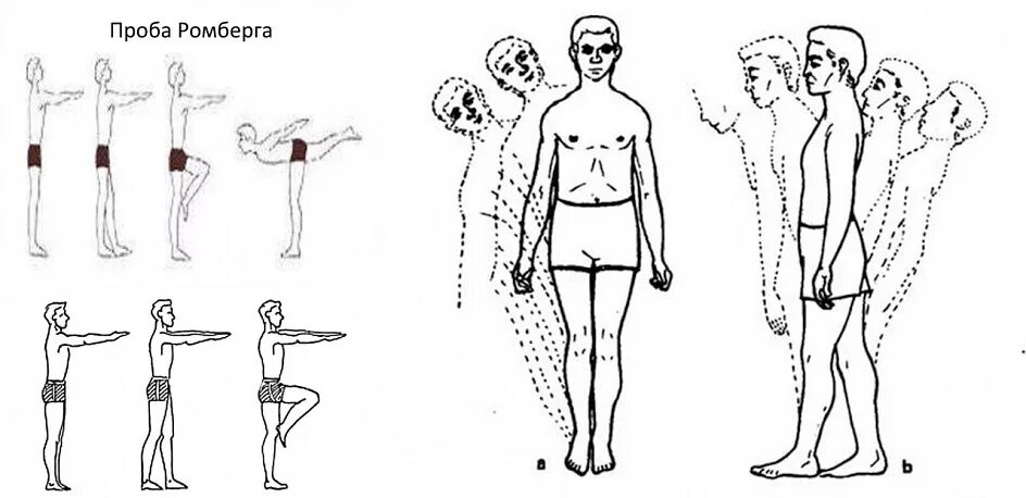 Испытание устойчивости в позе ромберга. Статическая балансировка проба ромберга. Проба ромберга 2. Неустойчивость в позе ромберга.