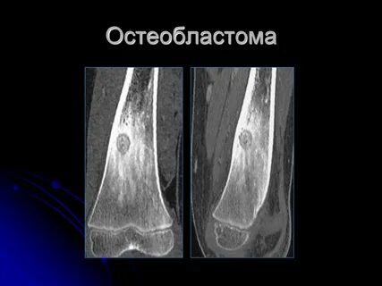 Костная опухоль