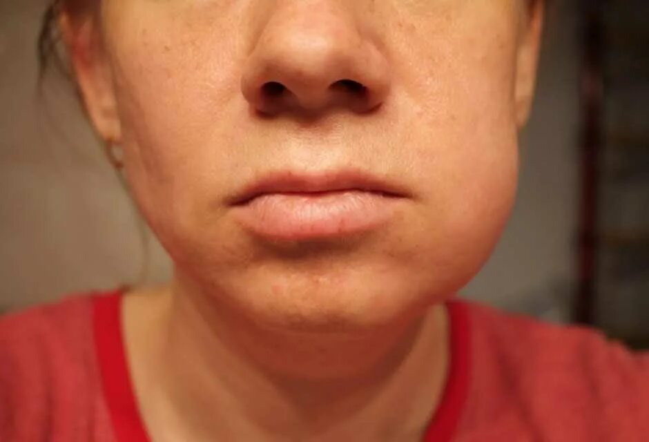 Неврит тройничного нерва симптомы. Асимметрия носогубных складок при улыбке. Здоровый высунутый язык. Онемело губы и подбородка. Онемело губы и подбородка.