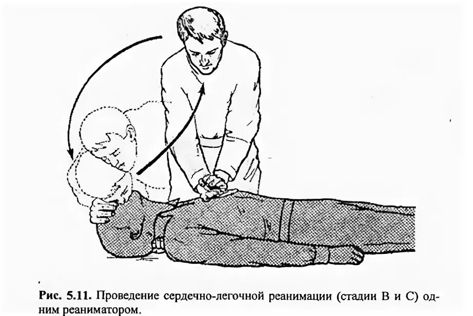 Проведение сердечно легочной реанимации одним спасателем. Схема проведения сердечно легочной реанимации. проведение сердечно легочной реанимации 1 человеком. рисунок сердечно легочная реанимация. этапы сердечно-легочной реанимации картинки.