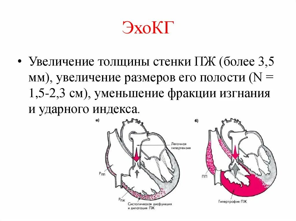 Увеличение объема желудочков сердечный выброс