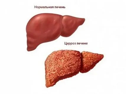 Светлая печень причины